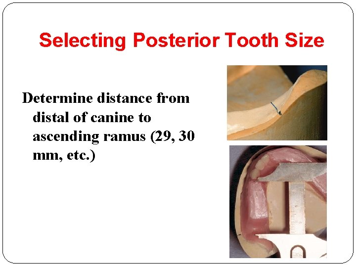 Selecting Posterior Tooth Size Determine distance from distal of canine to ascending ramus (29,
