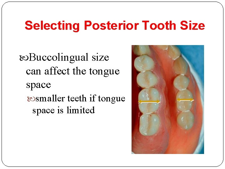 Selecting Posterior Tooth Size Buccolingual size can affect the tongue space smaller teeth if