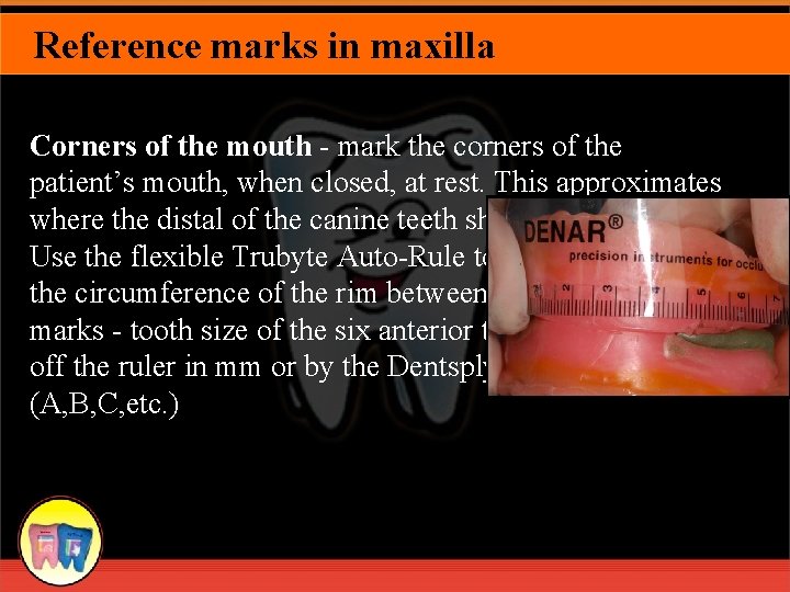 Reference marks in maxilla Corners of the mouth - mark the corners of the