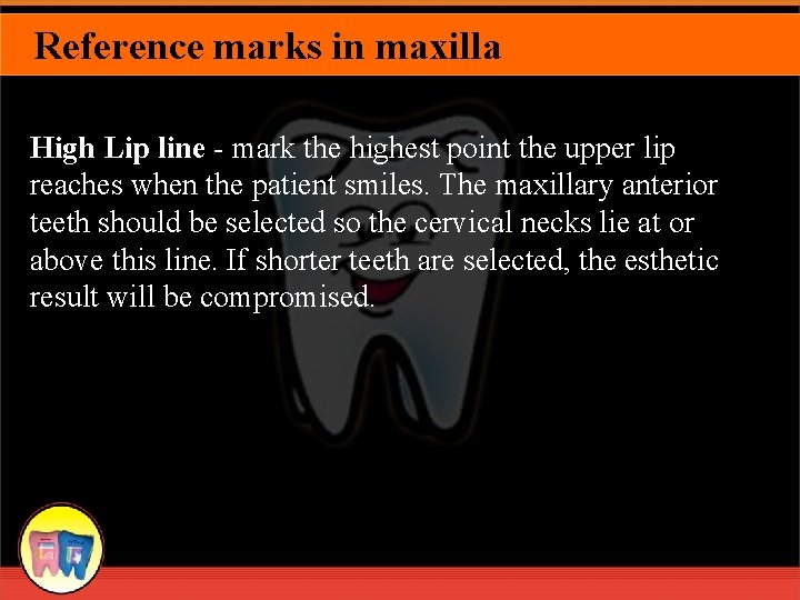 Reference marks in maxilla High Lip line - mark the highest point the upper