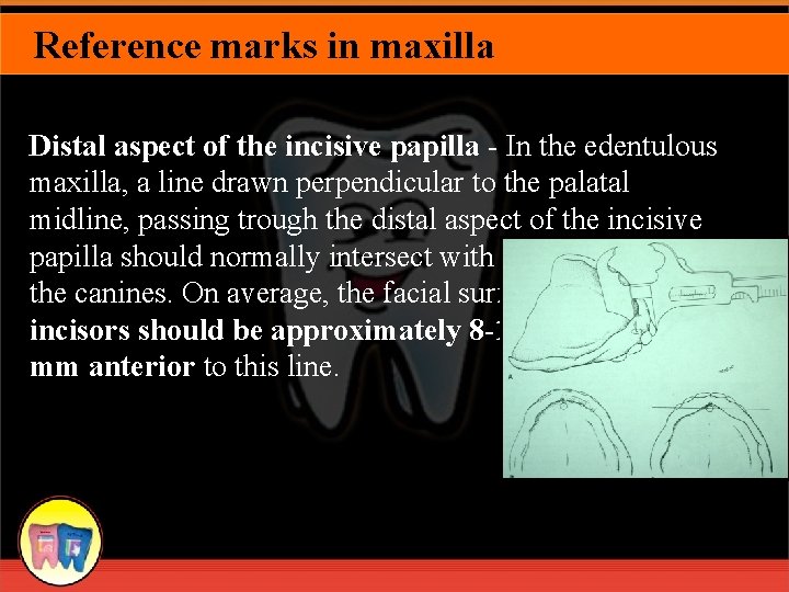 Reference marks in maxilla Distal aspect of the incisive papilla - In the edentulous