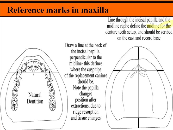 Reference marks in maxilla 