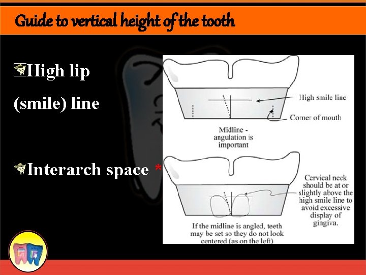 Guide to vertical height of the tooth High lip (smile) line Interarch space *