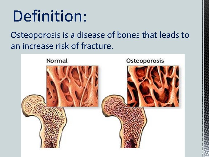 Definition: Osteoporosis is a disease of bones that leads to an increase risk of