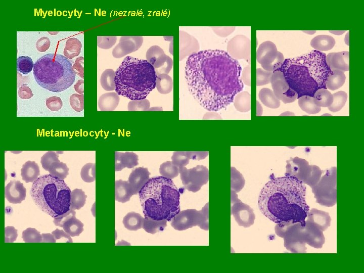 Myelocyty – Ne (nezralé, zralé) Metamyelocyty - Ne 