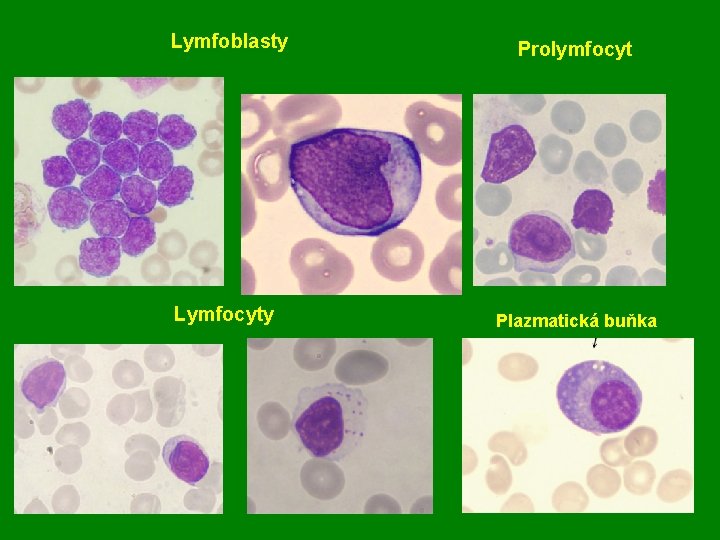 Lymfoblasty Prolymfocyt Lymfocyty Plazmatická buňka 
