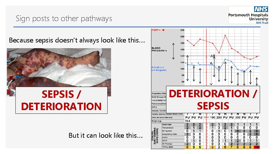 Sign posts to other pathways Because sepsis doesn’t always look like this…. SEPSIS /
