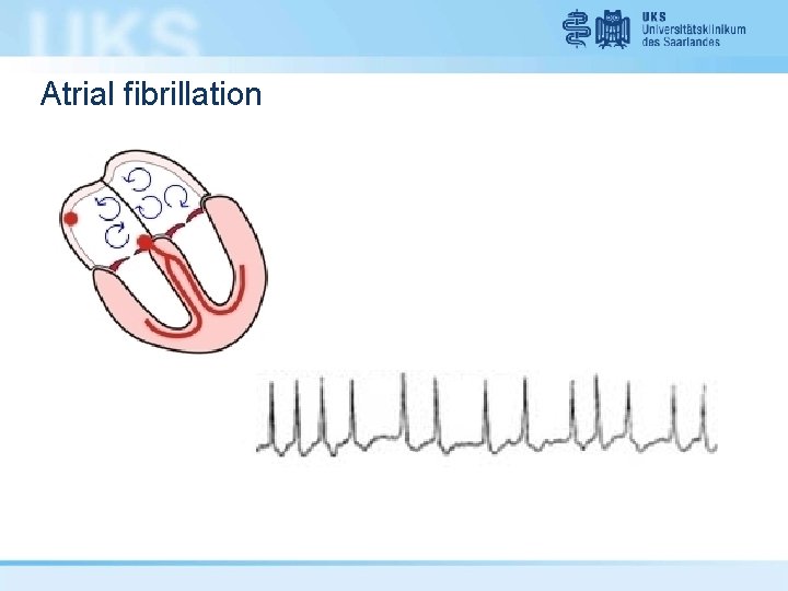 Atrial fibrillation 