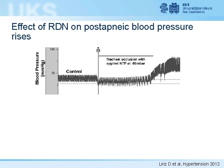 Effect of RDN on postapneic blood pressure rises Linz D et al, Hypertension 2012