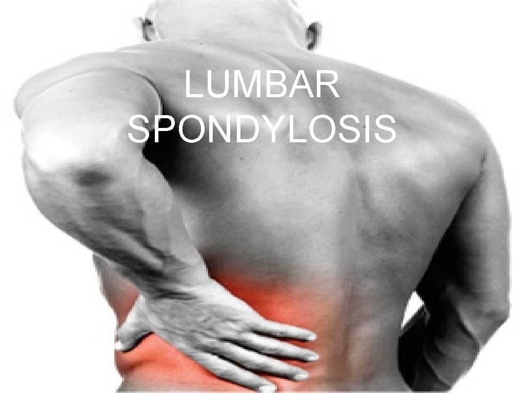 LUMBAR SPONDYLOSIS Definition Lumbar spondylosis is a medical