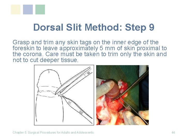 Dorsal Slit Method: Step 9 Grasp and trim any skin tags on the inner Dorsal Slit Method: Step 9 Grasp and trim any skin tags on the inner