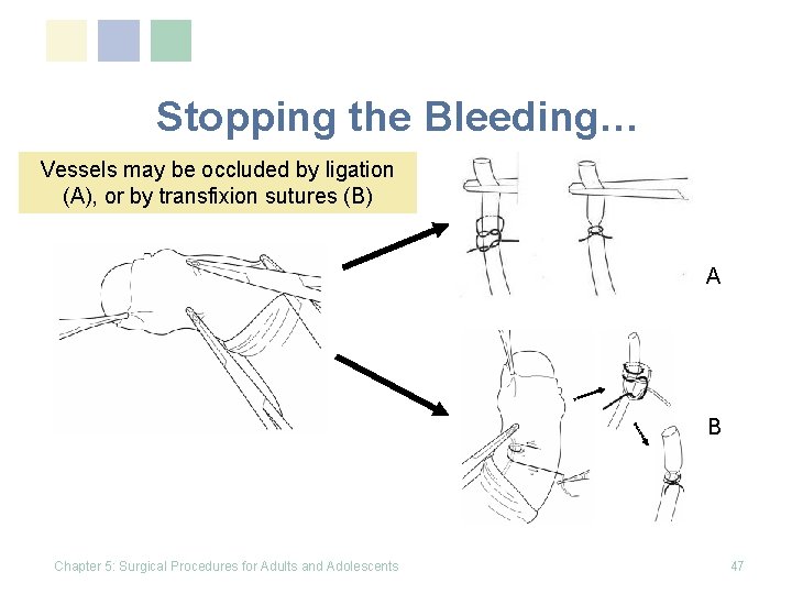 Stopping the Bleeding… Vessels may be occluded by ligation (A), or by transfixion sutures Stopping the Bleeding… Vessels may be occluded by ligation (A), or by transfixion sutures