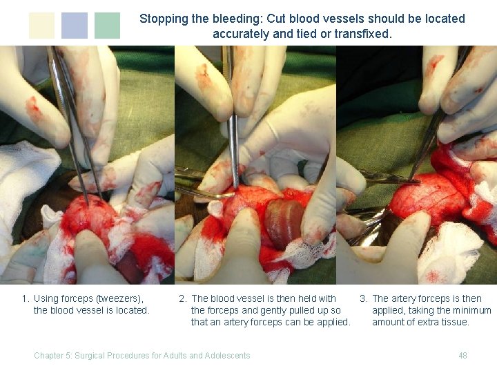 Stopping the bleeding: Cut blood vessels should be located accurately and tied or transfixed. Stopping the bleeding: Cut blood vessels should be located accurately and tied or transfixed.