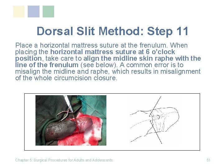Dorsal Slit Method: Step 11 Place a horizontal mattress suture at the frenulum. When Dorsal Slit Method: Step 11 Place a horizontal mattress suture at the frenulum. When