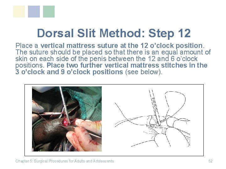 Dorsal Slit Method: Step 12 Place a vertical mattress suture at the 12 o’clock Dorsal Slit Method: Step 12 Place a vertical mattress suture at the 12 o’clock