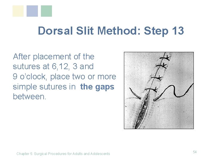 Dorsal Slit Method: Step 13 After placement of the sutures at 6, 12, 3 Dorsal Slit Method: Step 13 After placement of the sutures at 6, 12, 3