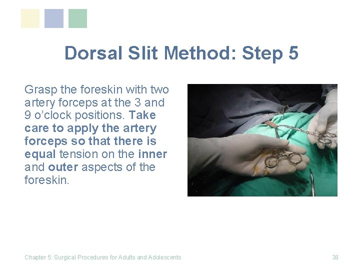 Dorsal Slit Method: Step 5 Grasp the foreskin with two artery forceps at the Dorsal Slit Method: Step 5 Grasp the foreskin with two artery forceps at the