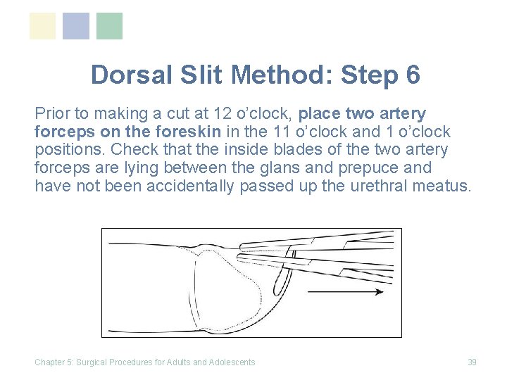 Dorsal Slit Method: Step 6 Prior to making a cut at 12 o’clock, place Dorsal Slit Method: Step 6 Prior to making a cut at 12 o’clock, place