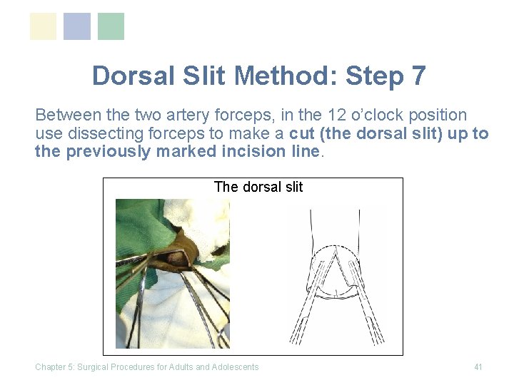 Dorsal Slit Method: Step 7 Between the two artery forceps, in the 12 o’clock Dorsal Slit Method: Step 7 Between the two artery forceps, in the 12 o’clock