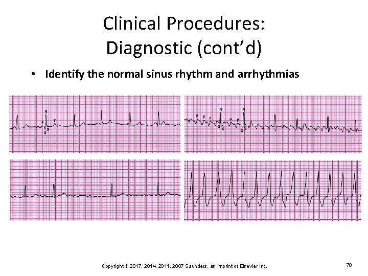 Clinical Procedures: Diagnostic (cont’d) • Identify the normal sinus rhythm and arrhythmias Copyright ©