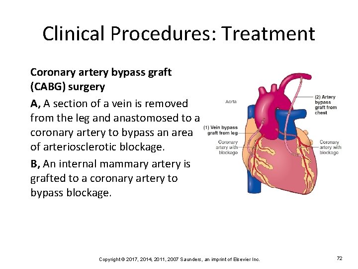 Clinical Procedures: Treatment Coronary artery bypass graft (CABG) surgery A, A section of a