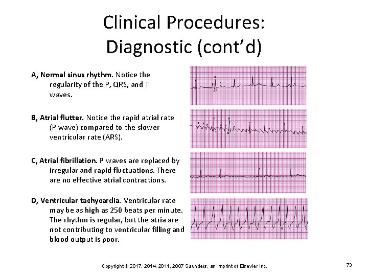 Clinical Procedures: Diagnostic (cont’d) A, Normal sinus rhythm. Notice the regularity of the P,