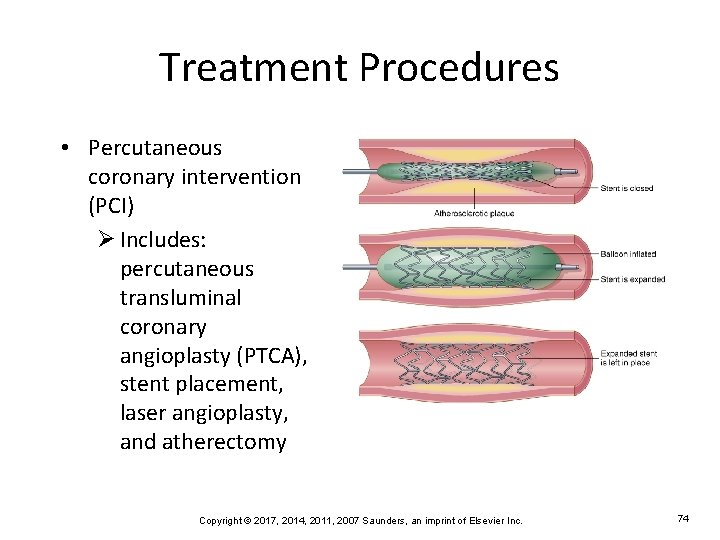 Treatment Procedures • Percutaneous coronary intervention (PCI) Ø Includes: percutaneous transluminal coronary angioplasty (PTCA),