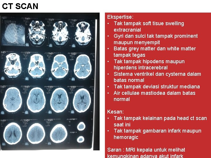 CT SCAN Ekspertise: • Tak tampak soft tisue swelling extracranial • Gyri dan sulci