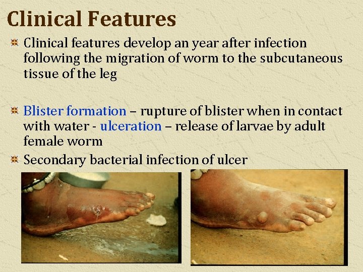 Clinical Features Clinical features develop an year after infection following the migration of worm