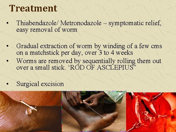 Treatment • Thiabendazole/ Metronodazole – symptomatic relief, easy removal of worm • Gradual extraction