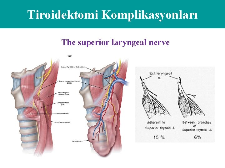 Tiroidektomi Komplikasyonları The superior laryngeal nerve 