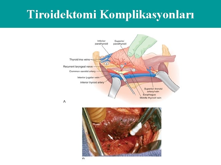 Tiroidektomi Komplikasyonları 