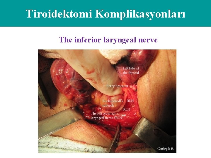 Tiroidektomi Komplikasyonları The inferior laryngeal nerve 