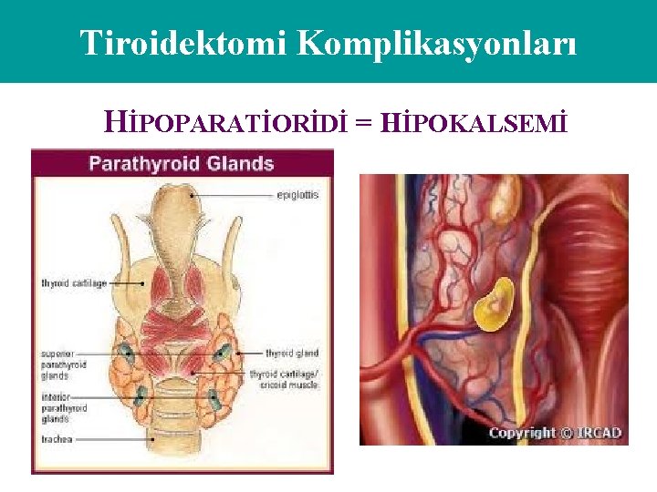 Tiroidektomi Komplikasyonları HİPOPARATİORİDİ = HİPOKALSEMİ 