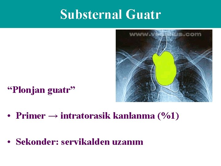 Substernal Guatr “Plonjan guatr” • Primer → intratorasik kanlanma (%1) • Sekonder: servikalden uzanım