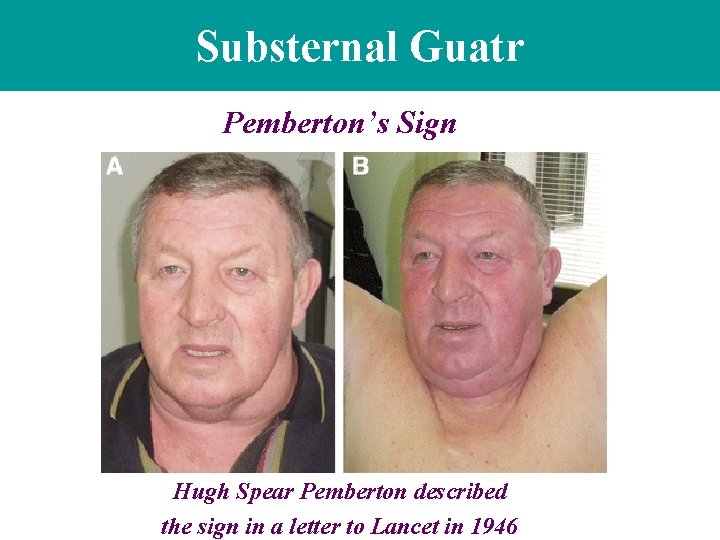 Substernal Guatr Pemberton’s Sign Hugh Spear Pemberton described the sign in a letter to