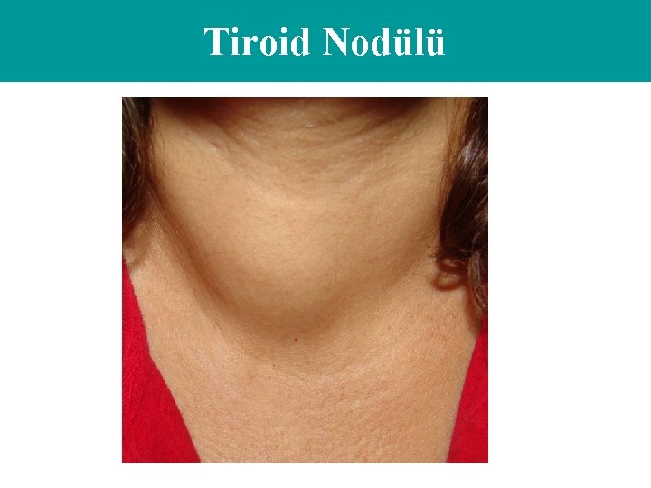 Tiroid Nodülü 