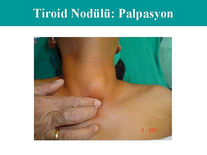 Tiroid Nodülü: Palpasyon 