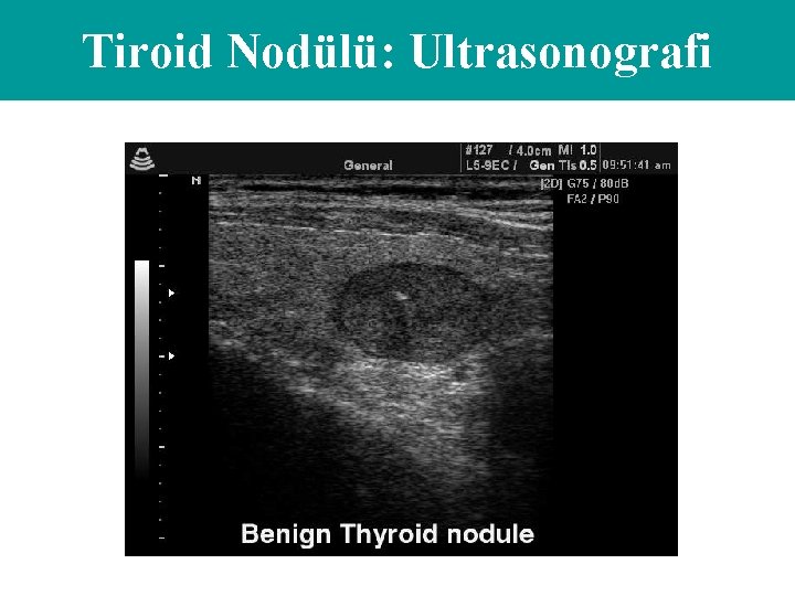 Tiroid Nodülü: Ultrasonografi 