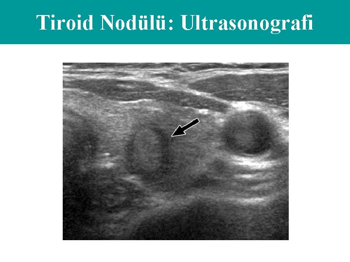 Tiroid Nodülü: Ultrasonografi 