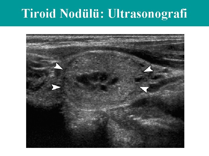 Tiroid Nodülü: Ultrasonografi 