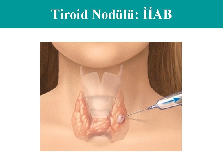 Tiroid Nodülü: İİAB 