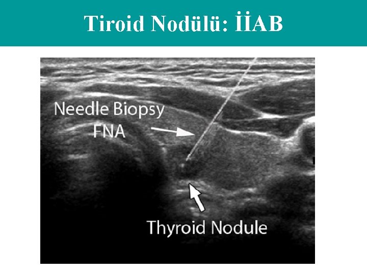 Tiroid Nodülü: İİAB 