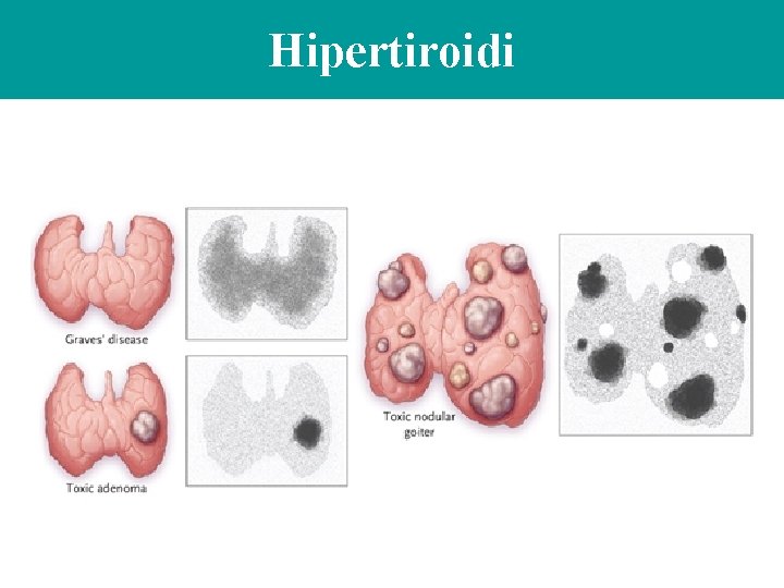 Hipertiroidi 