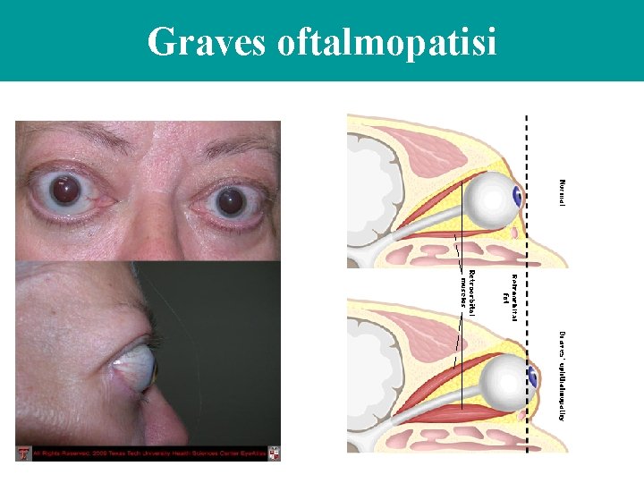 Graves oftalmopatisi 