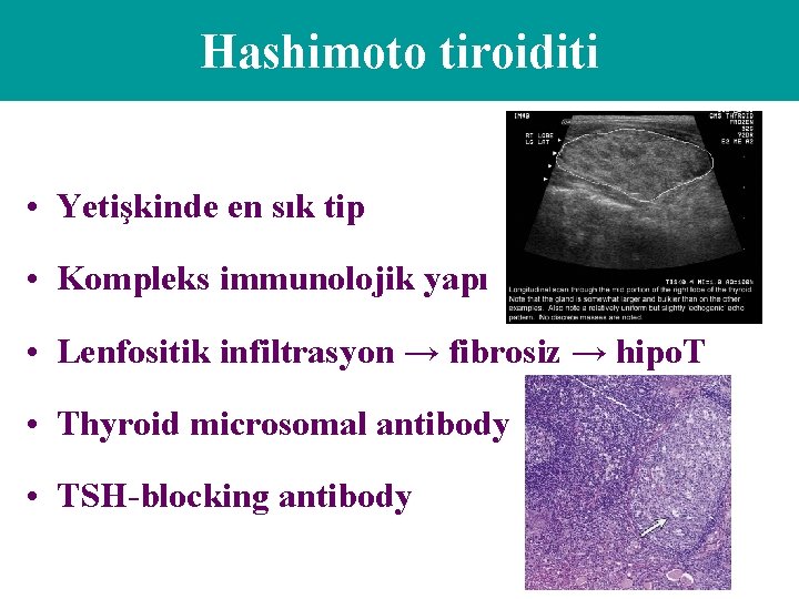 Hashimoto tiroiditi • Yetişkinde en sık tip • Kompleks immunolojik yapı • Lenfositik infiltrasyon