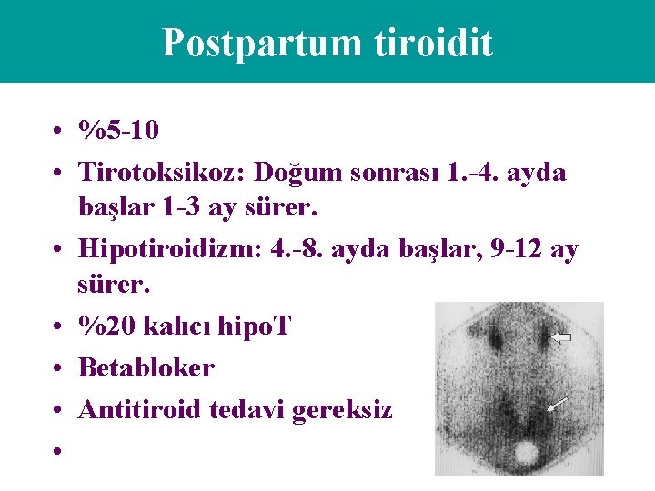 Postpartum tiroidit • %5 -10 • Tirotoksikoz: Doğum sonrası 1. -4. ayda başlar 1