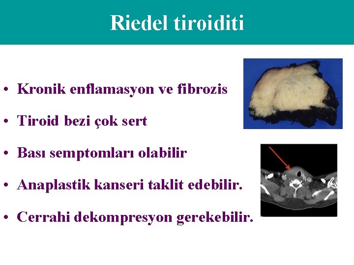 Riedel tiroiditi • Kronik enflamasyon ve fibrozis • Tiroid bezi çok sert • Bası