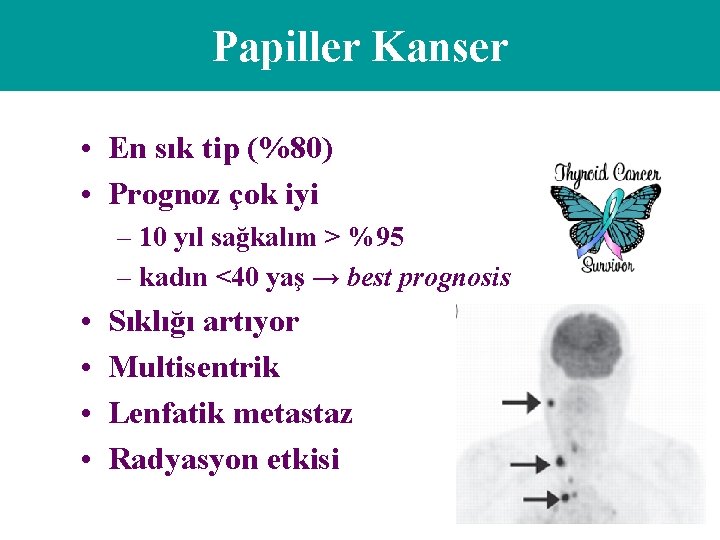 Papiller Kanser • En sık tip (%80) • Prognoz çok iyi – 10 yıl