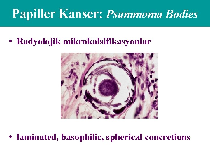 Papiller Kanser: Psammoma Bodies • Radyolojik mikrokalsifikasyonlar • laminated, basophilic, spherical concretions 